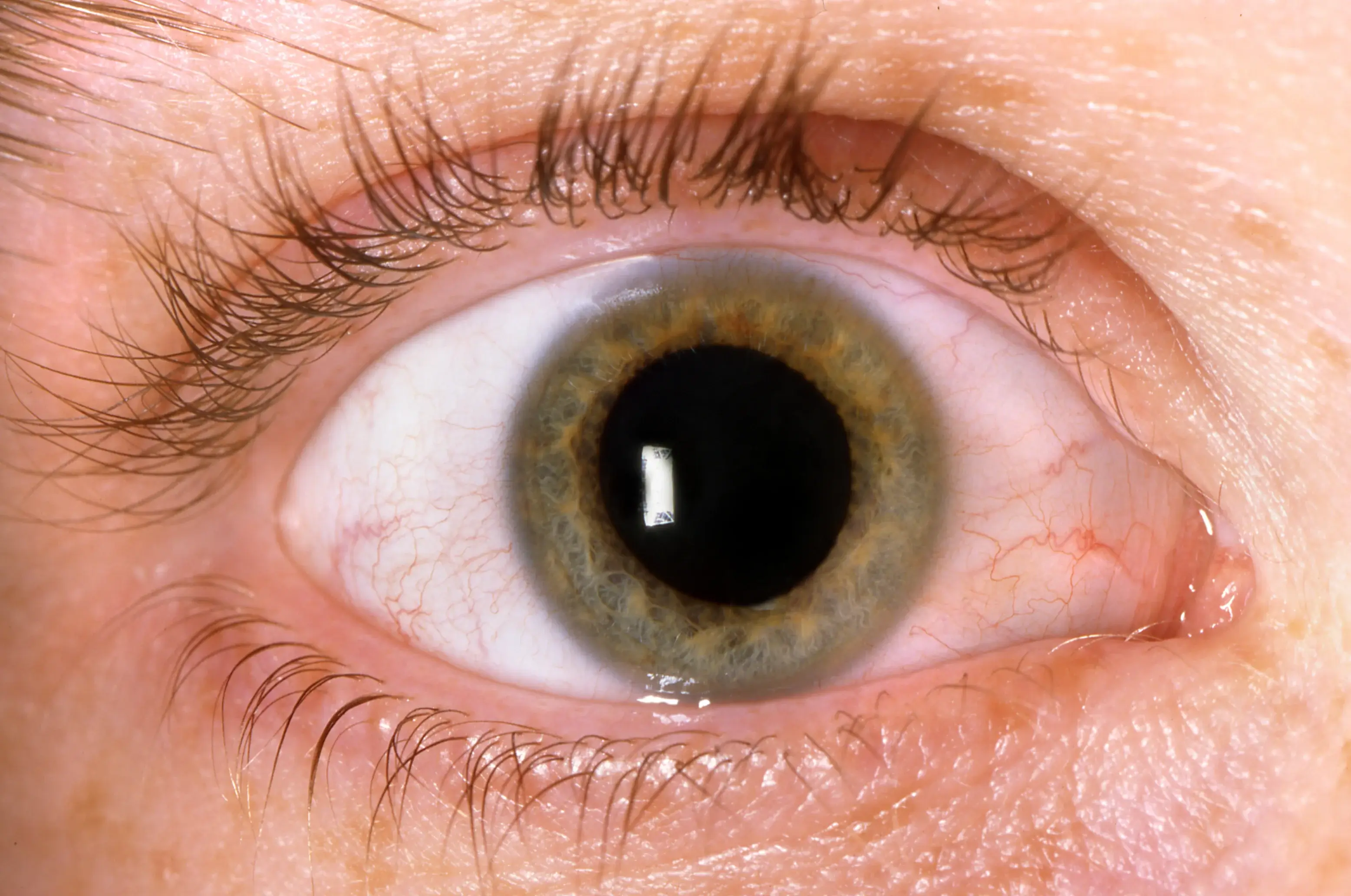 Ojo con retinopatía diabética. Síntomas de retinopatía diabética.
